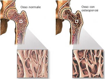 osteoporosi celiachia 